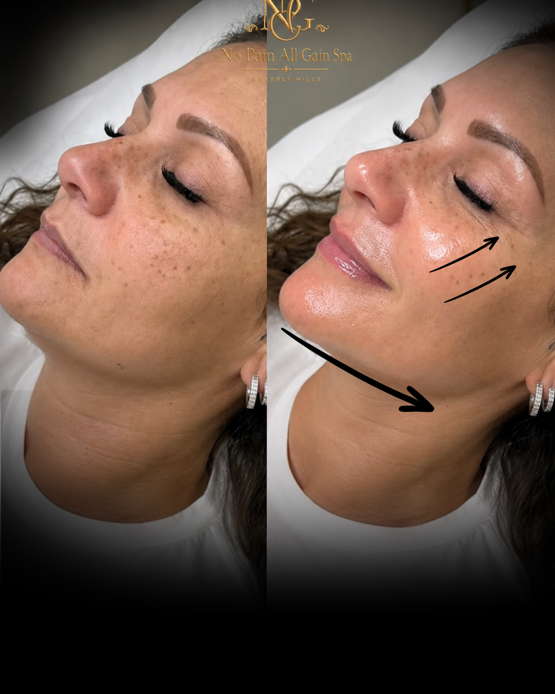 Comparison of a woman's face before and after skincare treatment at No Pain All Gain Spa, Beverly Hills, showing improved skin texture and the application of skincare products with arrows indicating areas of treatment