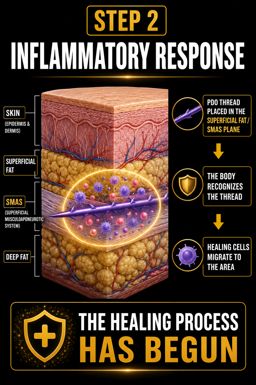 Diagram of skin layers and inflammatory response process, showing step 2 of healing. It illustrates skin, superficial fat, SMAS, and deep fat layers with a purple PDO thread placed in superficial fat/SMAS plane. The body recognizes the thread, healing cells migrate to the area, beginning the healing process.