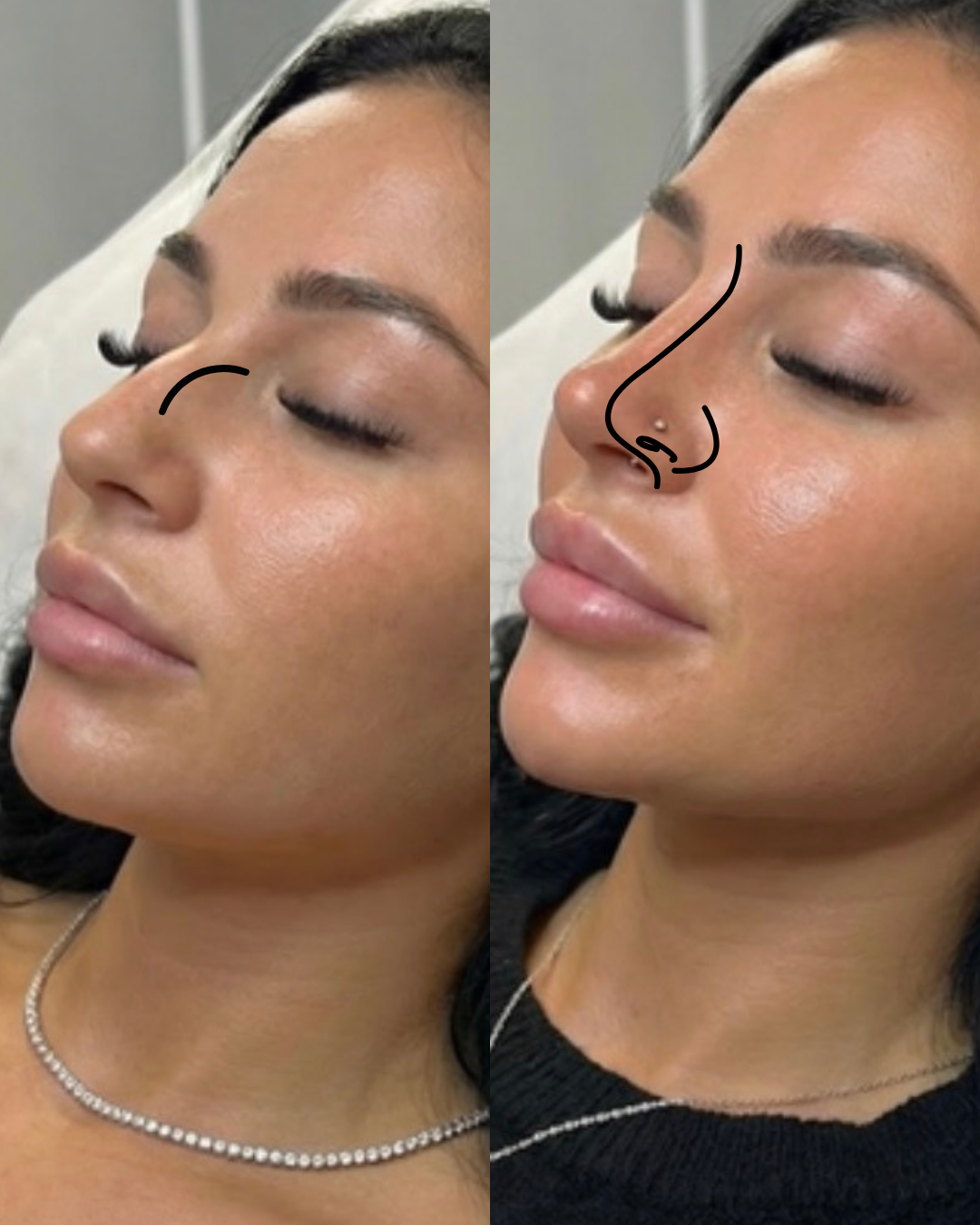 Side-by-side photos of a woman with closed eyes, showcasing a nose transformation, with hand-drawn outline of her nose on each side.