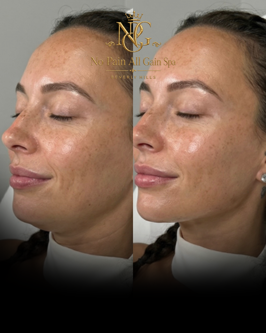 Before and after images showing skin improvement on a woman's face, with focus on freckles and skin tone, from a beauty or skincare treatment at No Pain All Gain Spa in Beverly Hills.