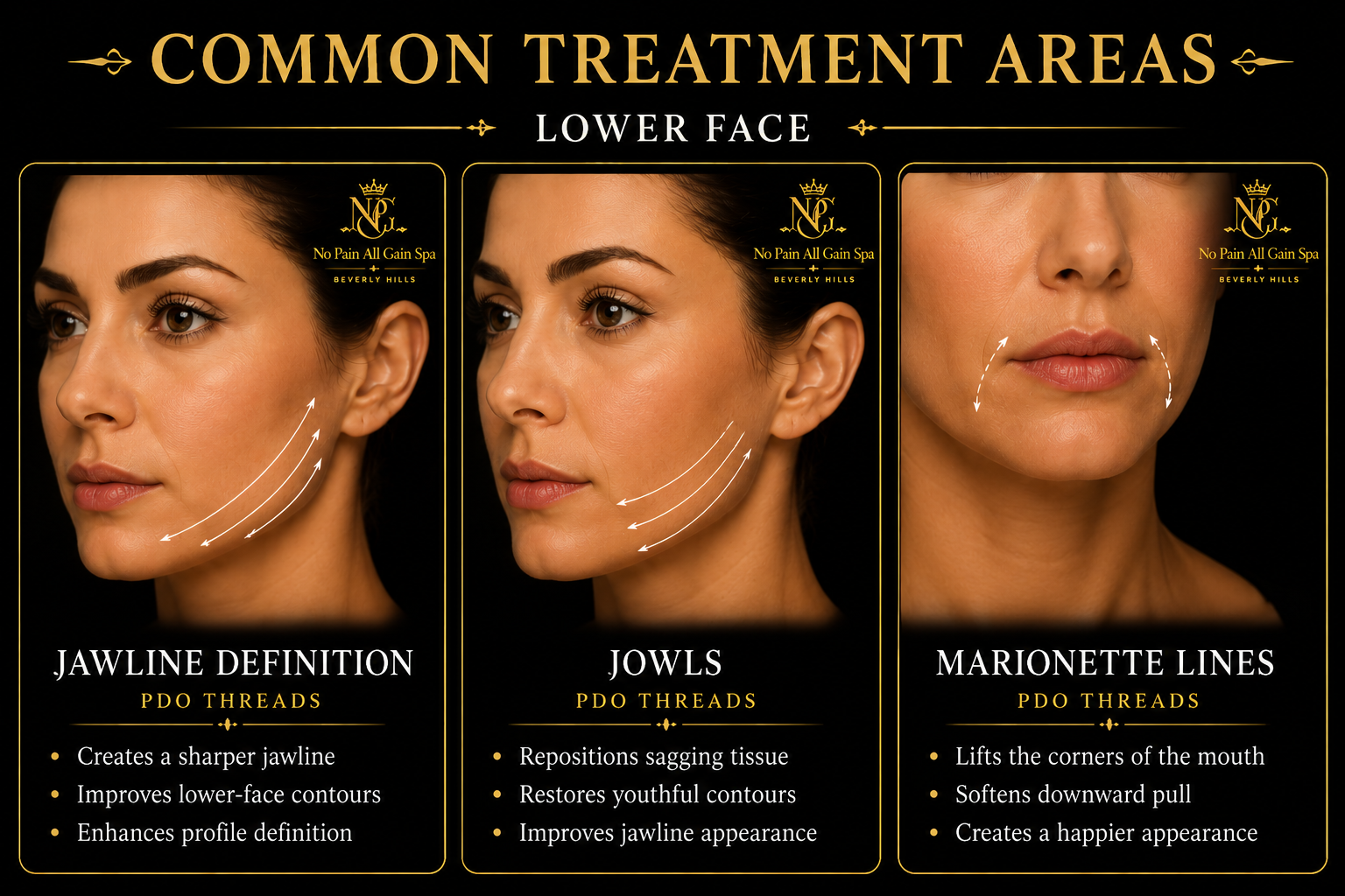 Infographic showing common treatment areas for lower face: jawline definition with PDO threads, jaw contours with PDO threads, and marionette lines with PDO threads, including descriptions of each treatment's benefits.