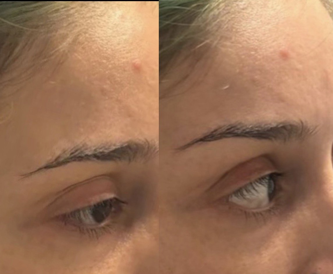 Comparison of a person's forehead and eyebrow before and after a treatment or skincare routine, showing improvement in skin texture and appearance.