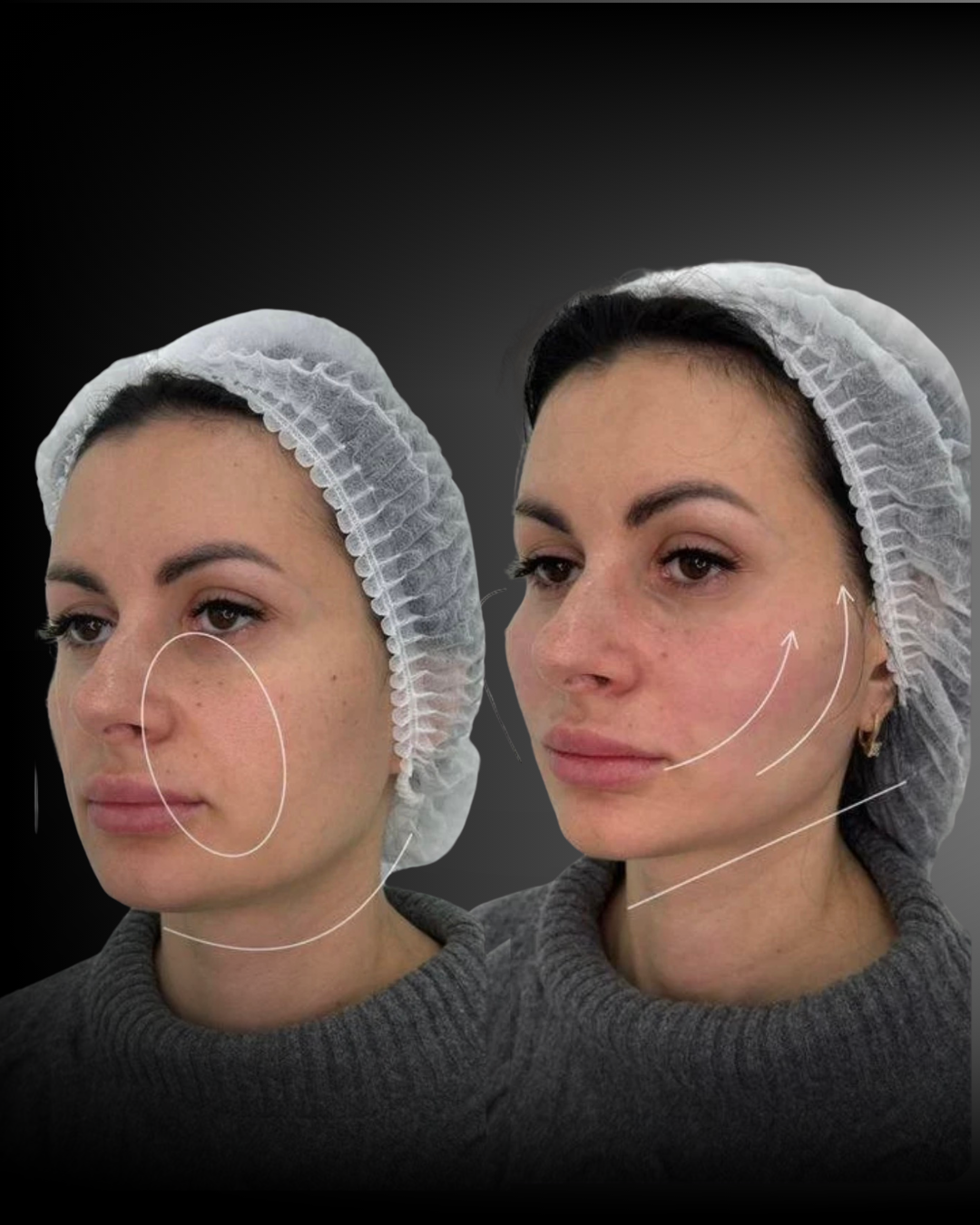 POSTS RADIESSE before & after - 27.png