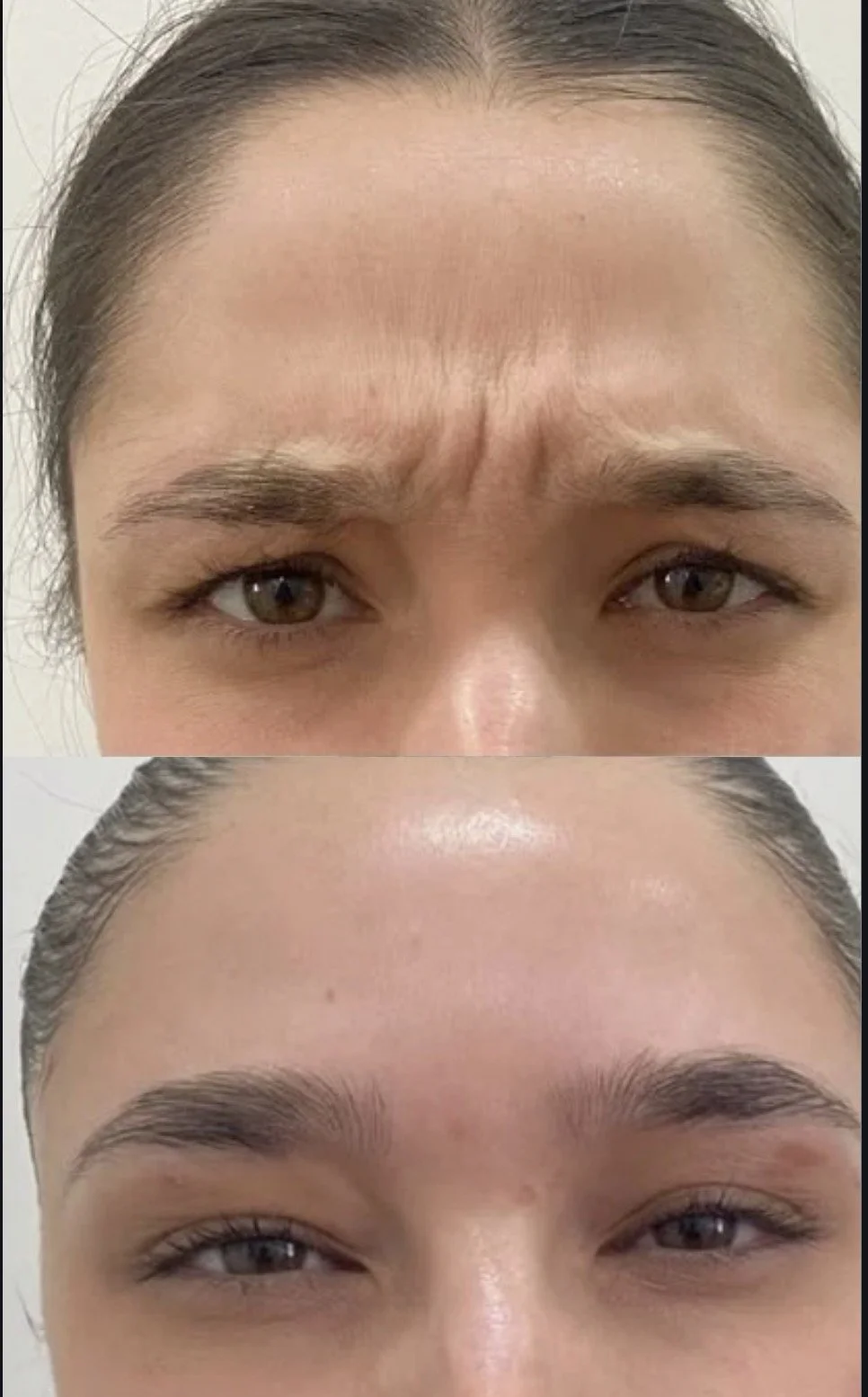 Comparison of a woman's eyebrows and forehead before and after cosmetic treatment or makeup, showing reduced wrinkles and fuller eyebrows.