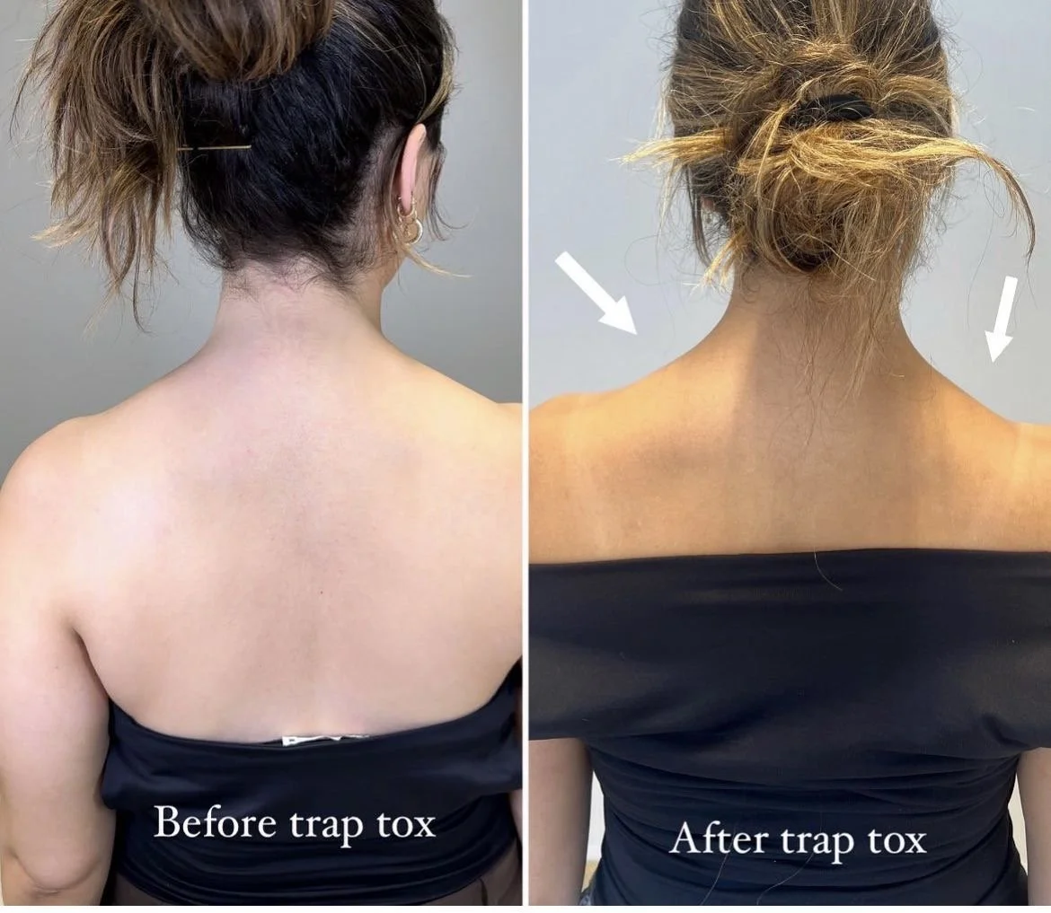 Side-by-side comparison of a woman's back before and after trap toxin treatment. The left shows the back before, with fuller muscle appearance and the right after, with a more relaxed and thinner look, indicated by white arrows. The woman is wearing 