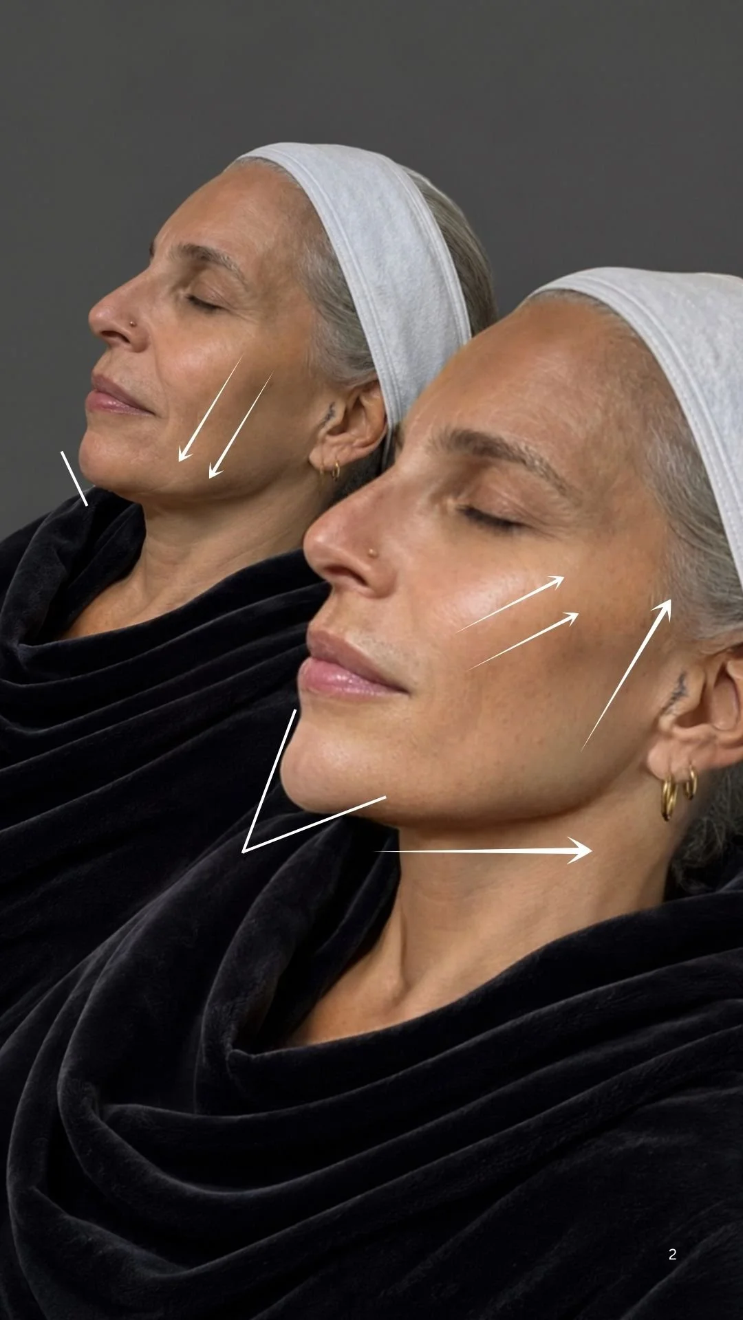 BEFORE AND AFTER PDO THREAD JAWLINE LIFT FOR JOWLS.