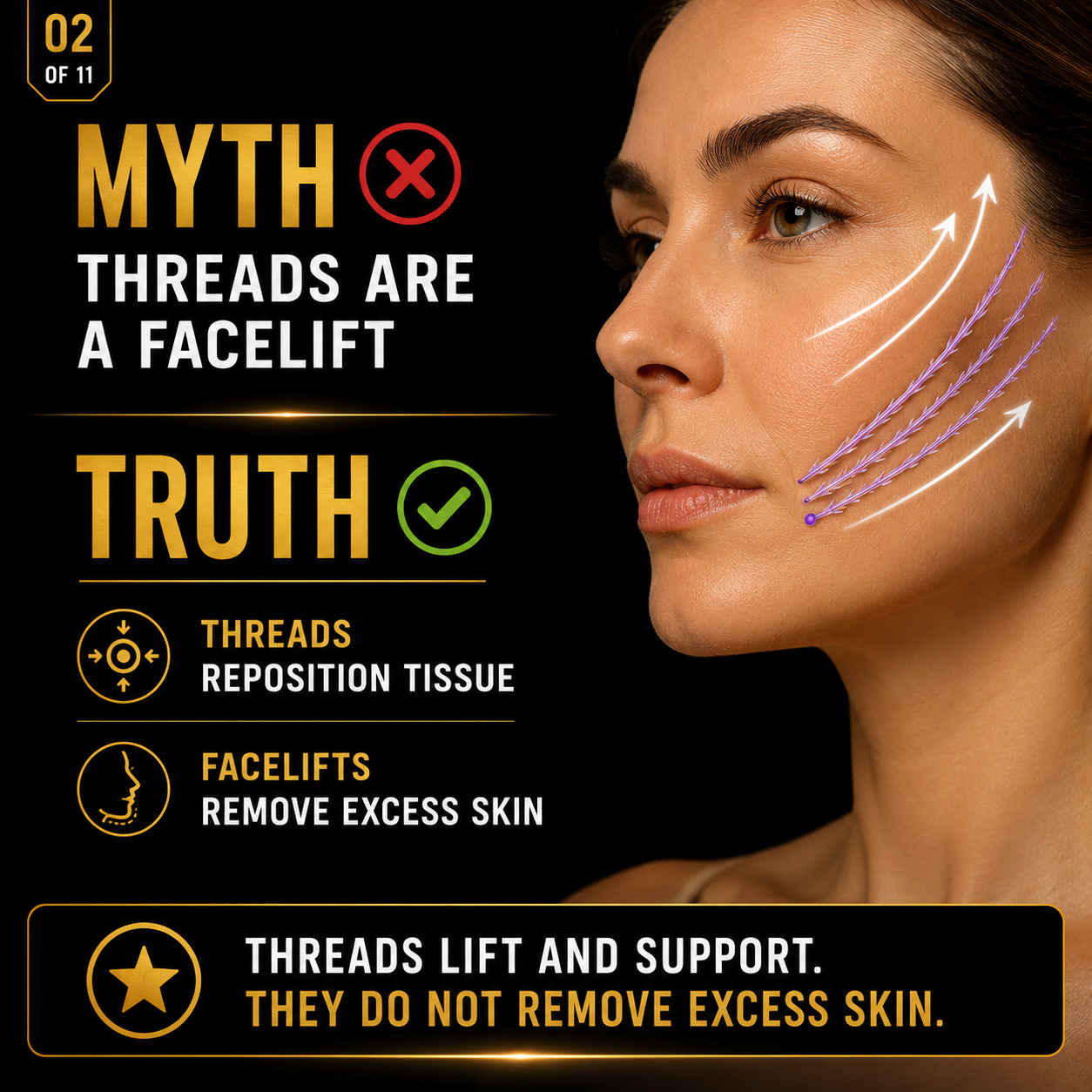An infographic explaining that myths claim threads are a facelift, but the truth is that they lift and support skin without removing excess skin. It includes a photo of a woman with arrows and purple lines indicating the direction of thread lift support on her cheek, and icons illustrating threads, tissue repositioning, and facelifts.
