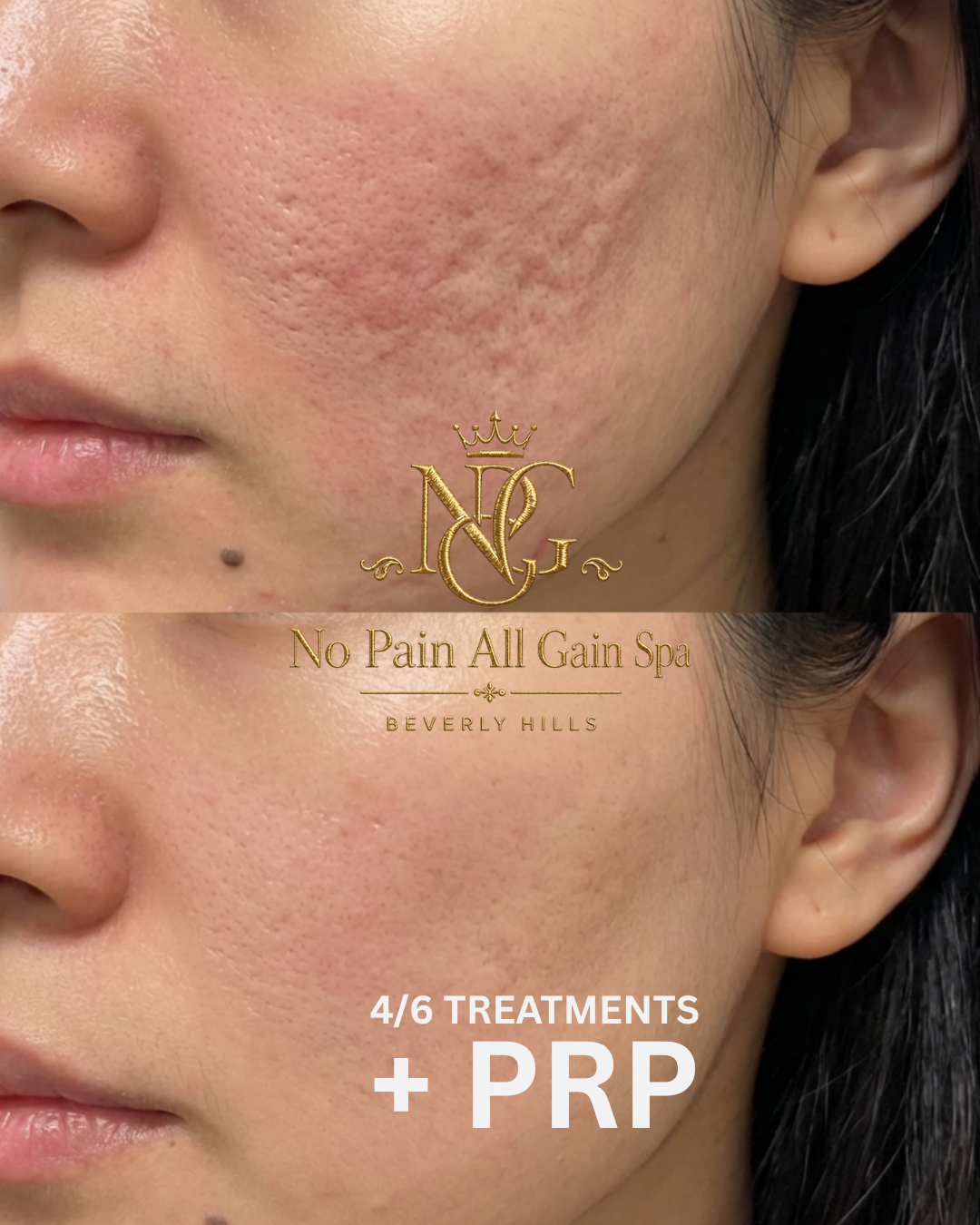 Before and after images showing the improvement of facial skin texture and reduction of acne scars after skincare treatments, with text indicating 4 out of 6 treatments completed and PRP therapy. The images are branded with 'No Pain All Gain Spa Beve