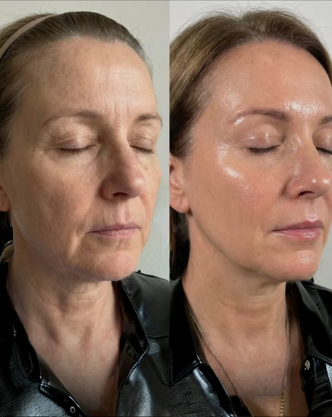LIQUID FACELIFT BEVERLY HILLS SCULPTRA