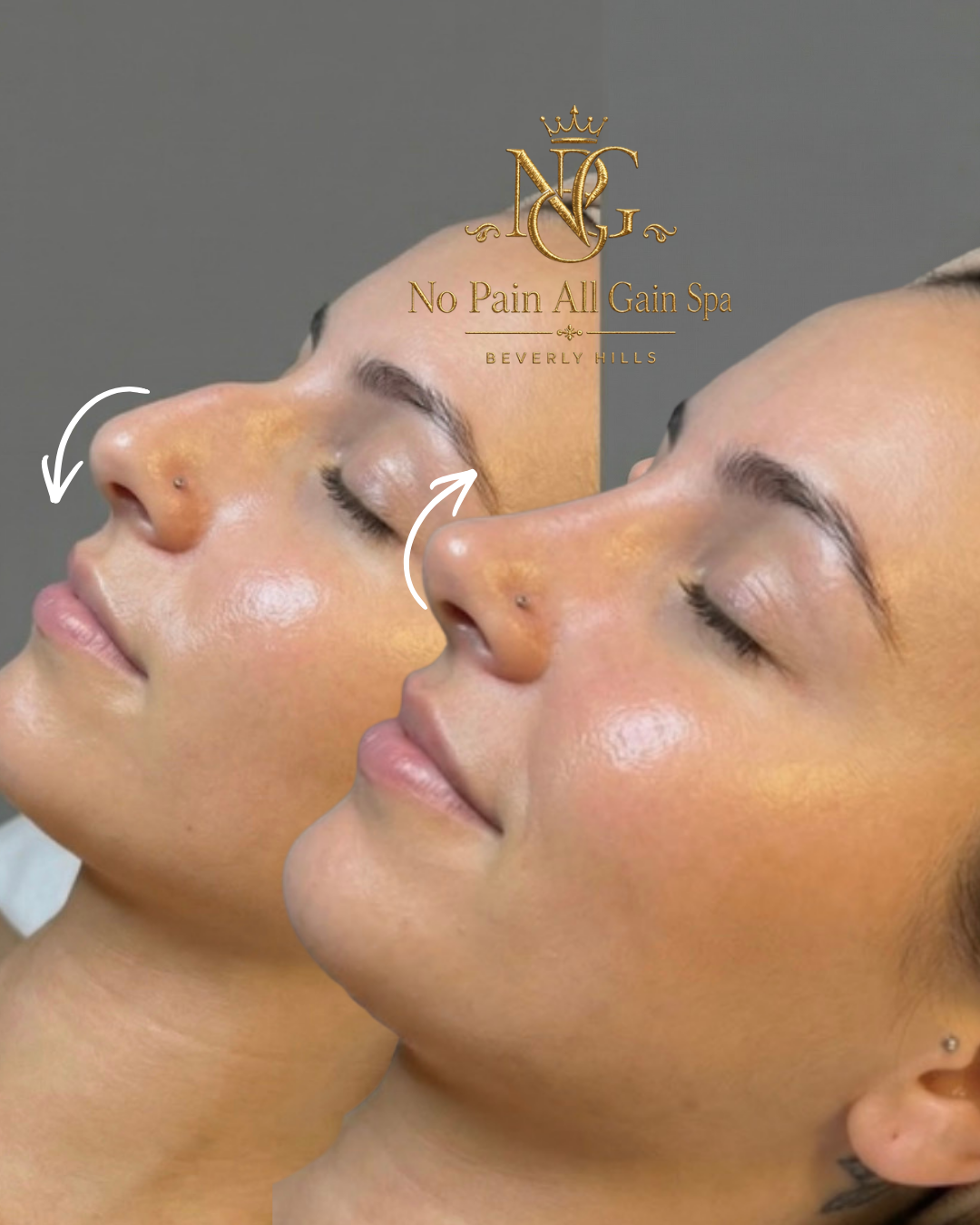 Side-by-side close-up of a woman's face showing before and after facial treatment, with a logo for No Pain All Gain Spa Beverly Hills in the background.
