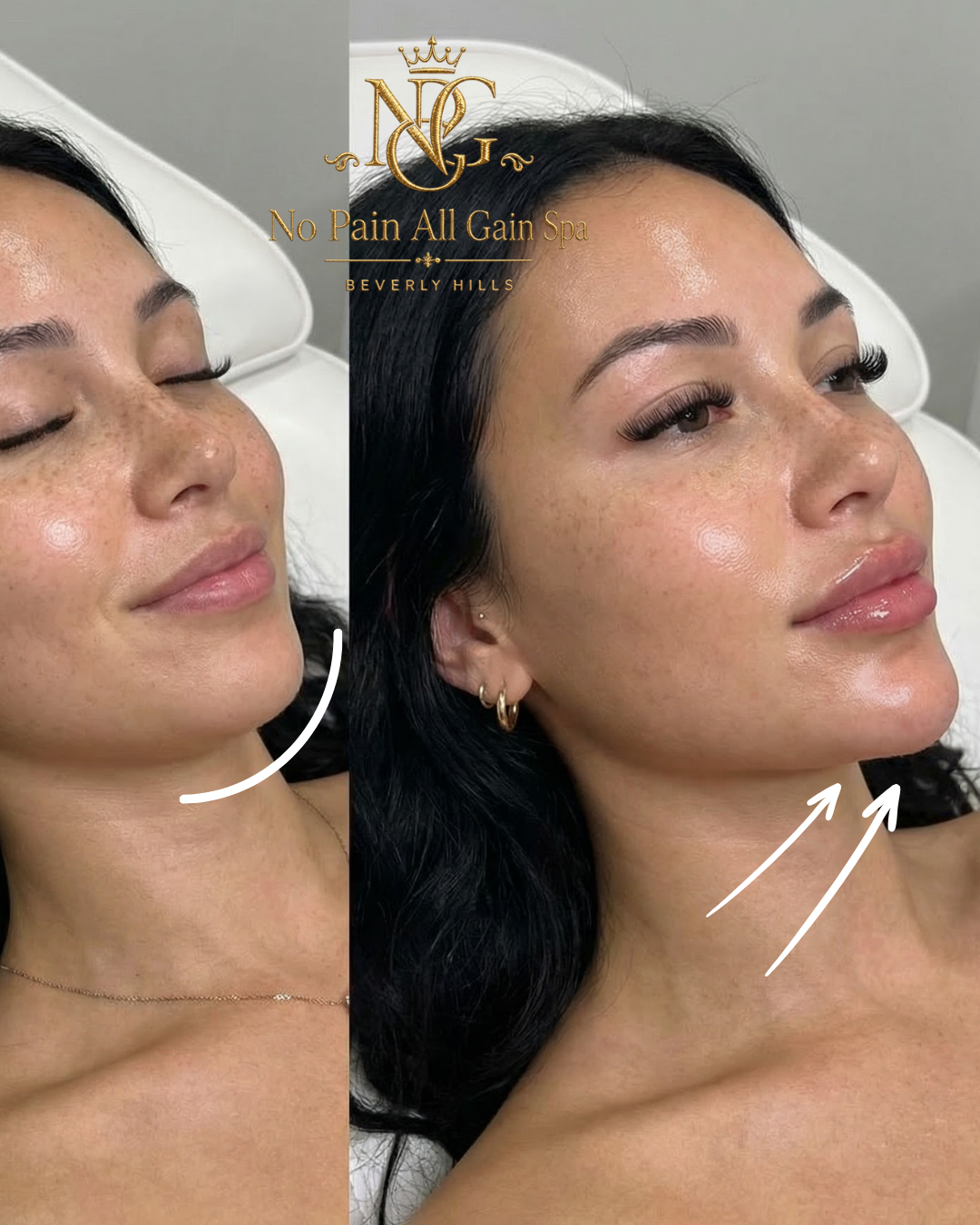 Before and after images of a woman's face showing improved skin appearance after treatment at No Pain All Gain Spa, Beverly Hills.