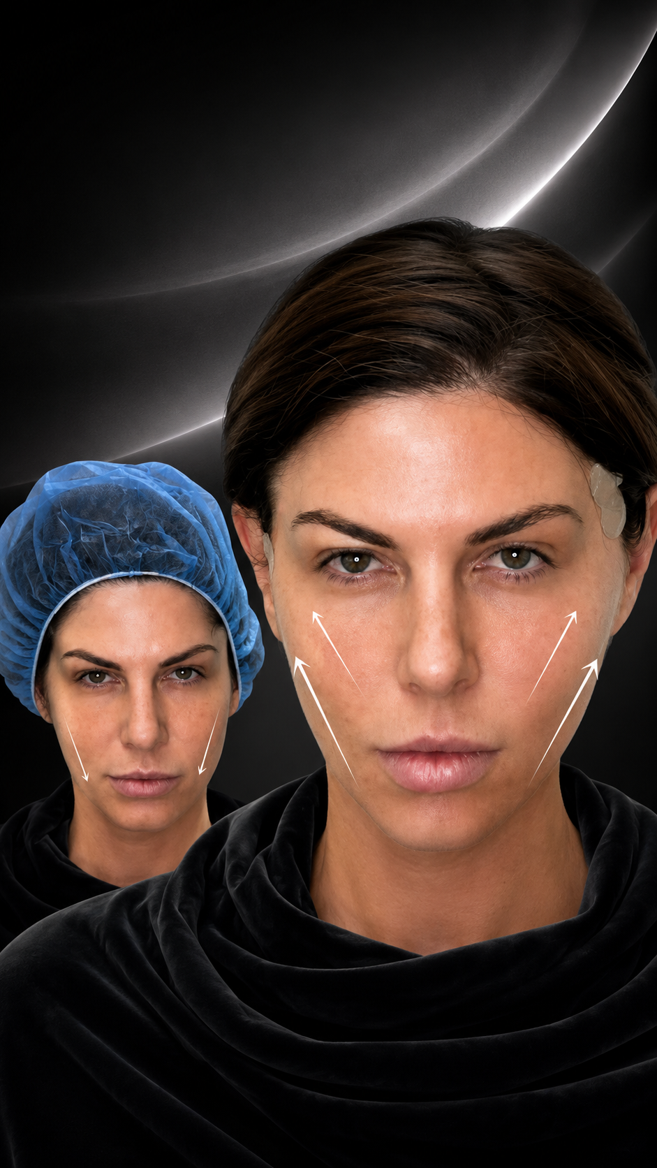 FULL FACE PDO THREAD LIFT BEFORE AND AFTER.