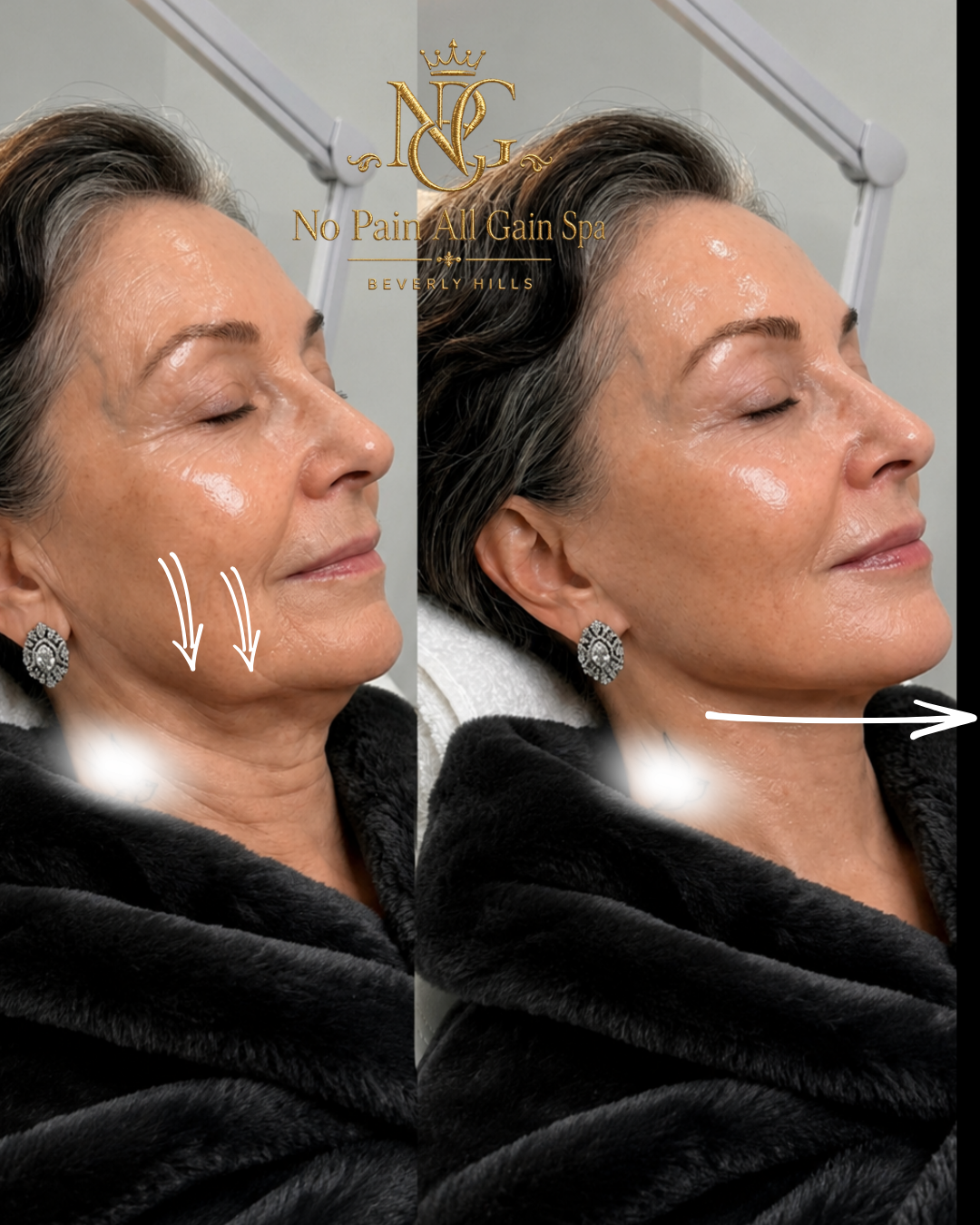 Side-by-side comparison of a woman before and after skincare or aesthetic treatment, showing improved skin texture and reduced wrinkles, with logo of No Pain All Gain Spa Beverly Hills.