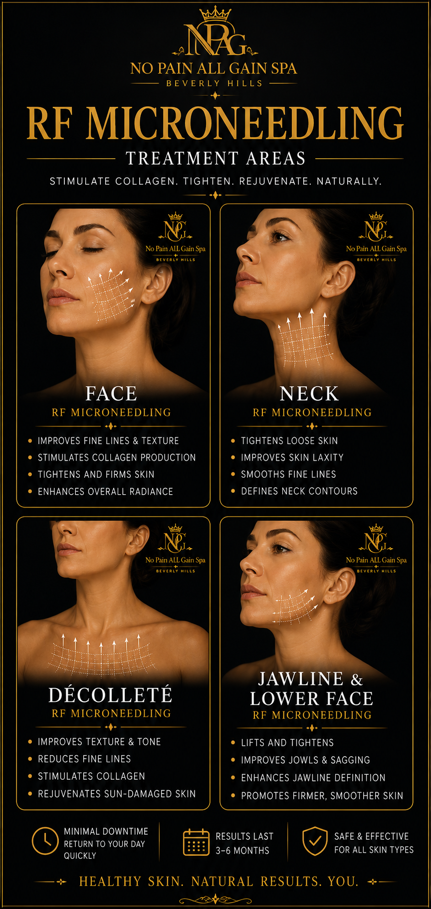 Infographic detailing RF Microneedling treatment areas for face, neck, décolleté, and jawline & lower face, with benefits listed for each area. The design features images of women with marked treatment zones, a dark background, and gold and white text.