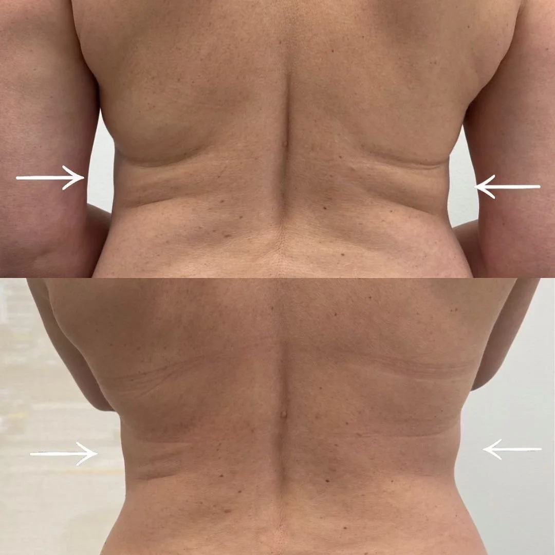 Comparison of two back images showing reduction in back fat or skin folds, with arrows pointing to the sides indicating the area of change.