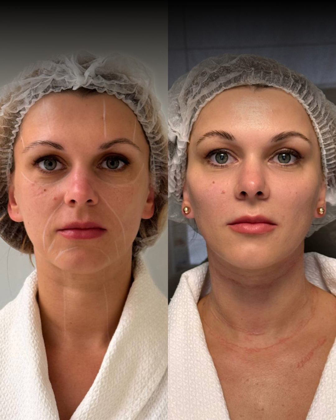 POSTS RADIESSE before & after - 25.png