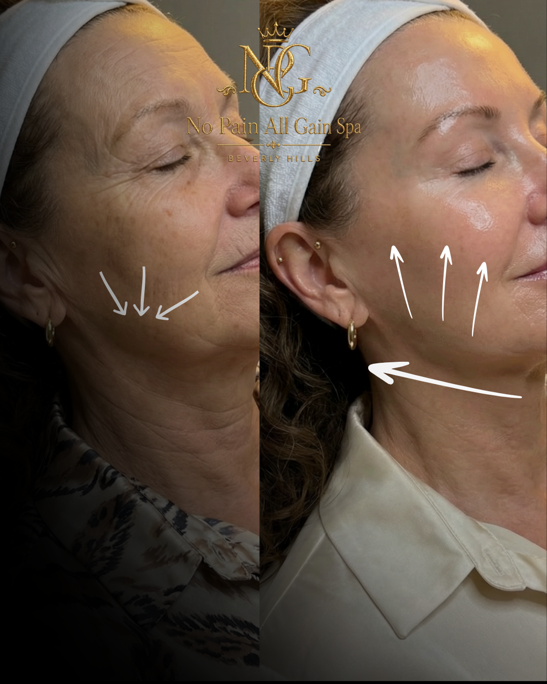 Side-by-side comparison of a woman before and after a skin treatment, showing improvements in skin texture and wrinkles, with arrows pointing to skin areas.