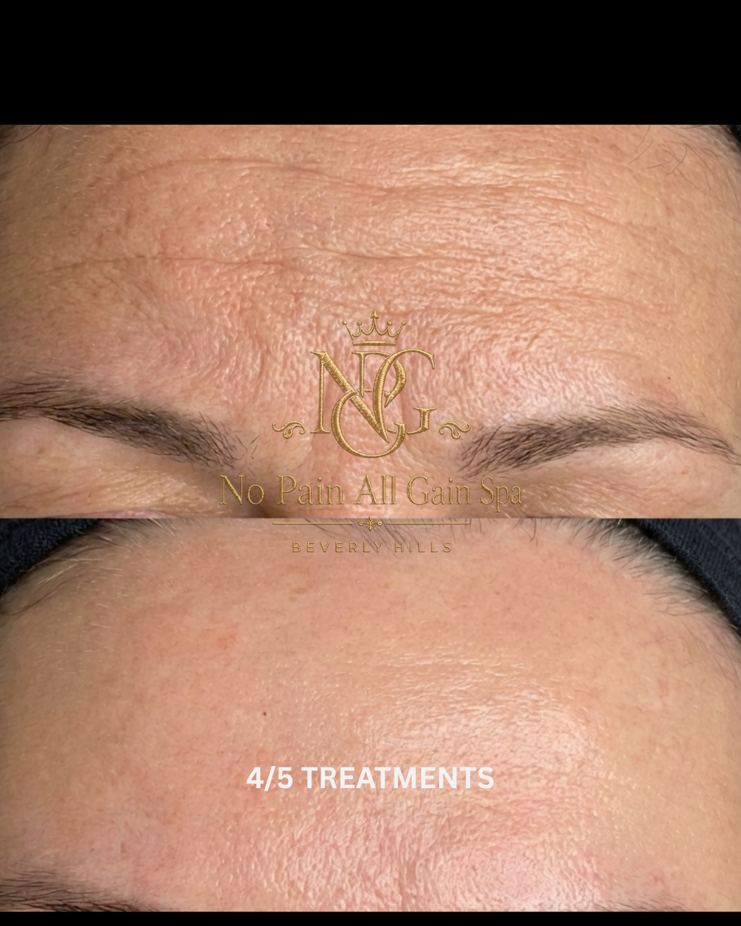 Comparison of forehead skin before and after facial treatments at No Pain All Gain Spa, Beverly Hills, showing improved skin clarity and texture with text indicating"4/5 treatments."