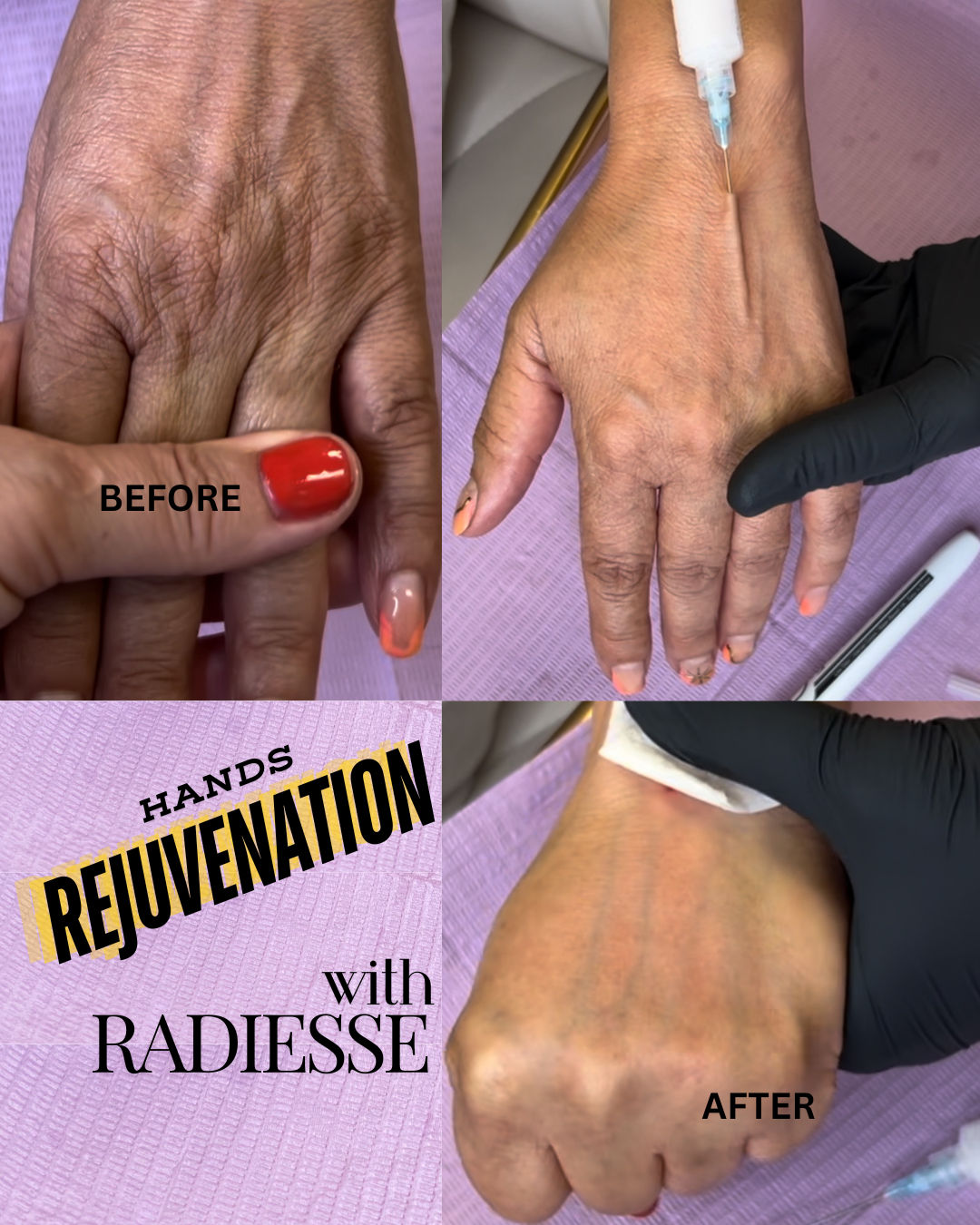 Sequential images showing a hand before and after a rejuvenation procedure with Radiesse. The 'before' image shows aged, wrinkled skin; the 'after' image shows smoother, more youthful skin after treatment.