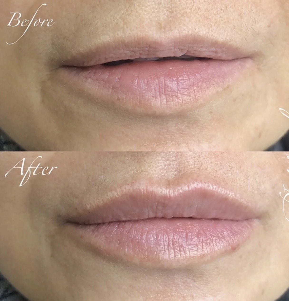Close-up of a person's lips before and after a cosmetic procedure, showing smoother lips and improved skin texture in the after image.