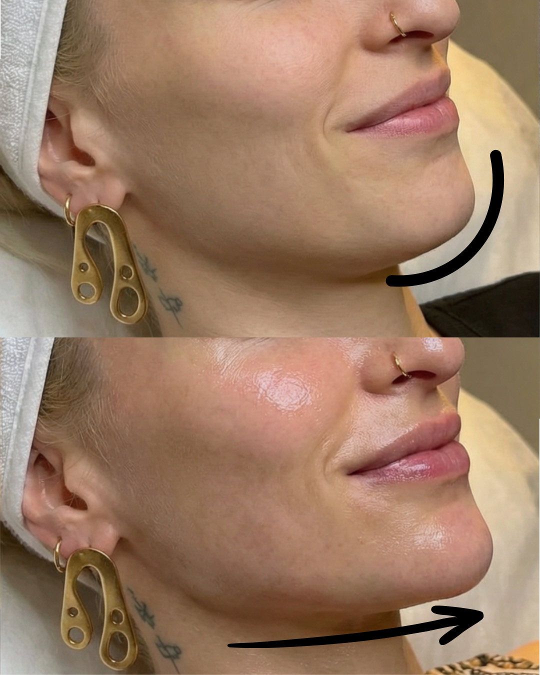 Comparison of a woman's jawline before and after a cosmetic procedure, showing a more defined jawline in the after image.
