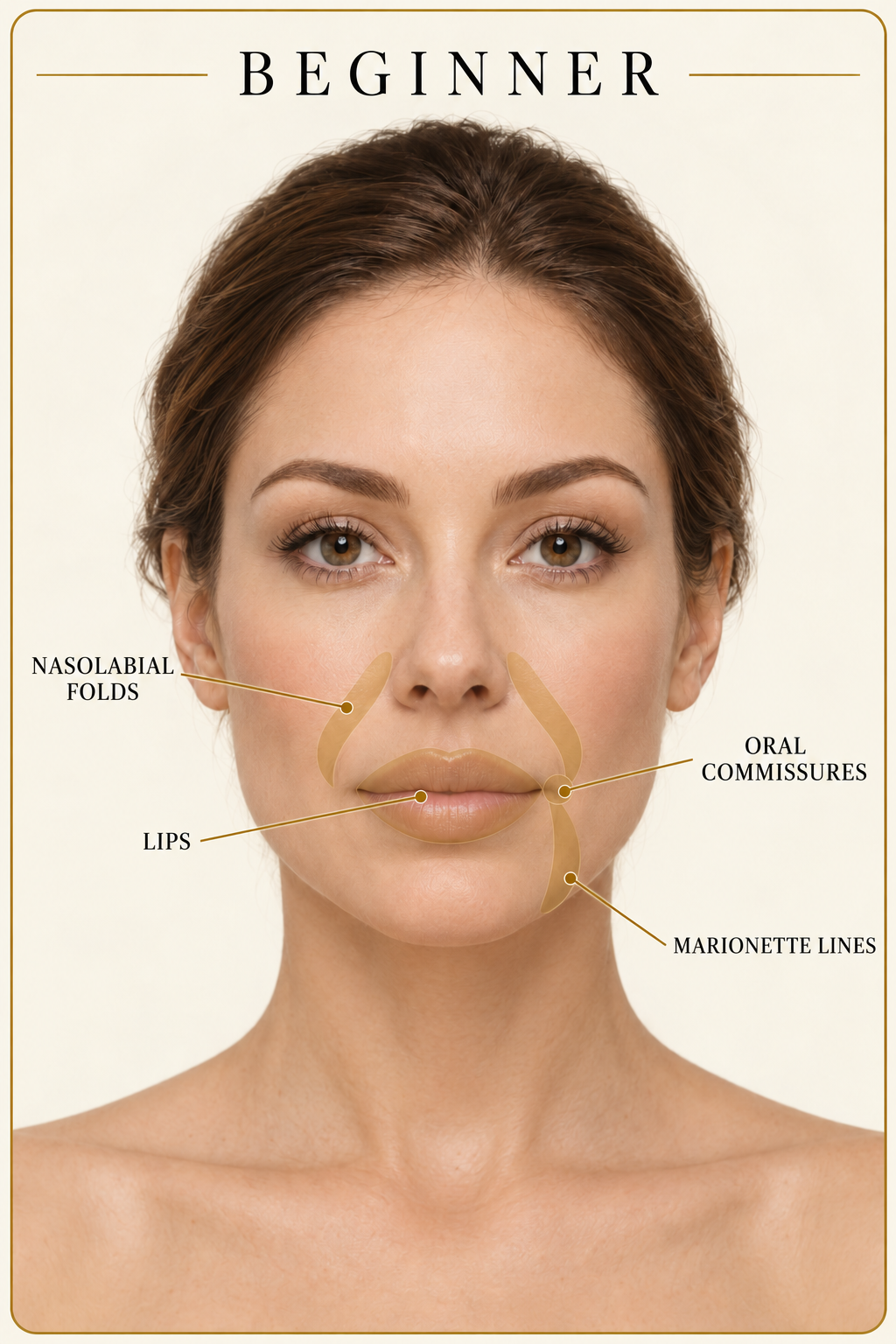 Beginner dermal filler treatment areas: lips, nasolabial folds, marionette lines, and oral commissures.