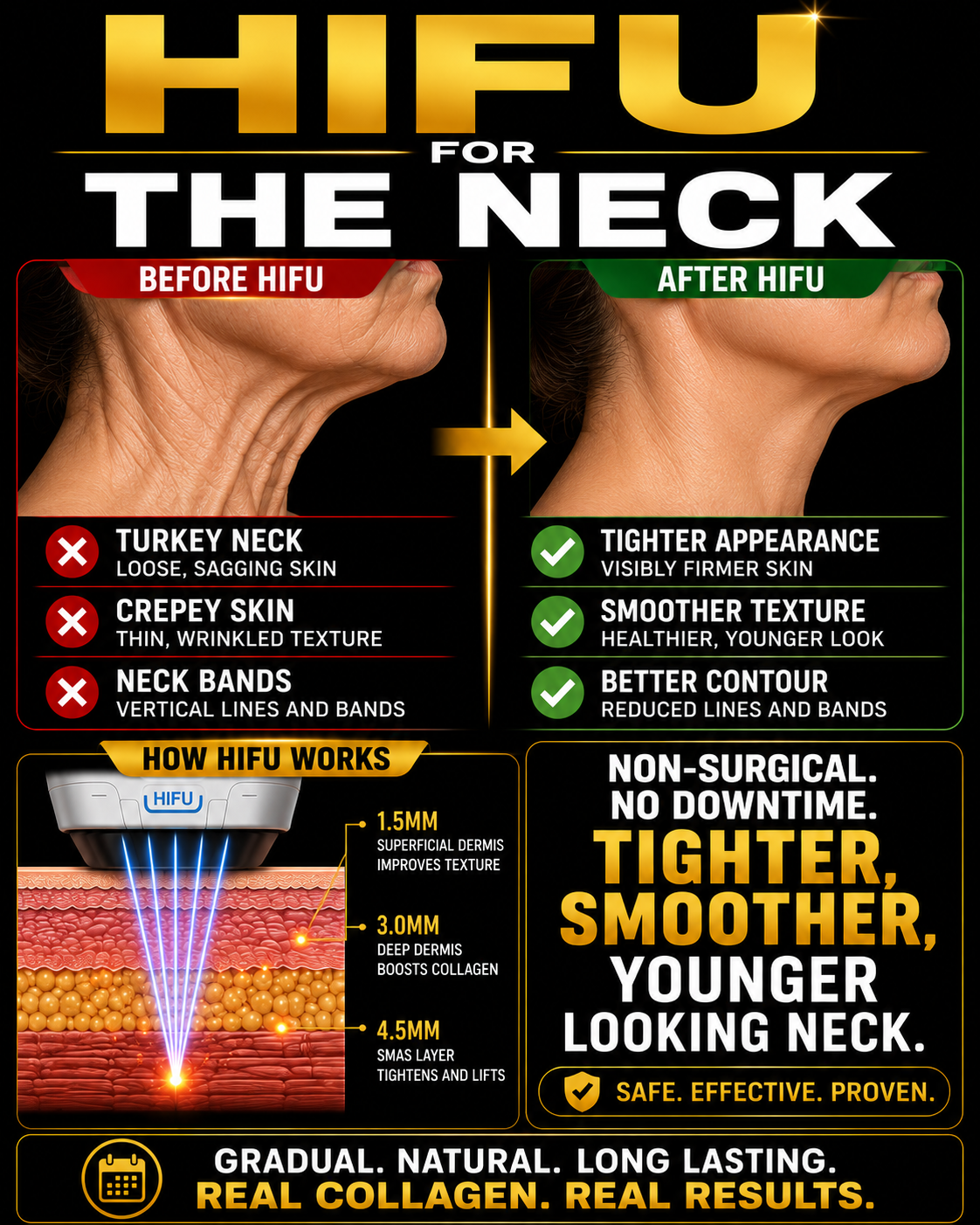 Comparison of neck skin before and after HIFU treatment. The 'before' image shows loose, sagging skin with neck bands, while the 'after' image shows visibly firmer, smoother, and better contoured skin. The poster explains how HIFU works with illustrations of the device targeting different skin layers, offering non-surgical, long-lasting results with collagen stimulation, emphasizing natural and proven effects.