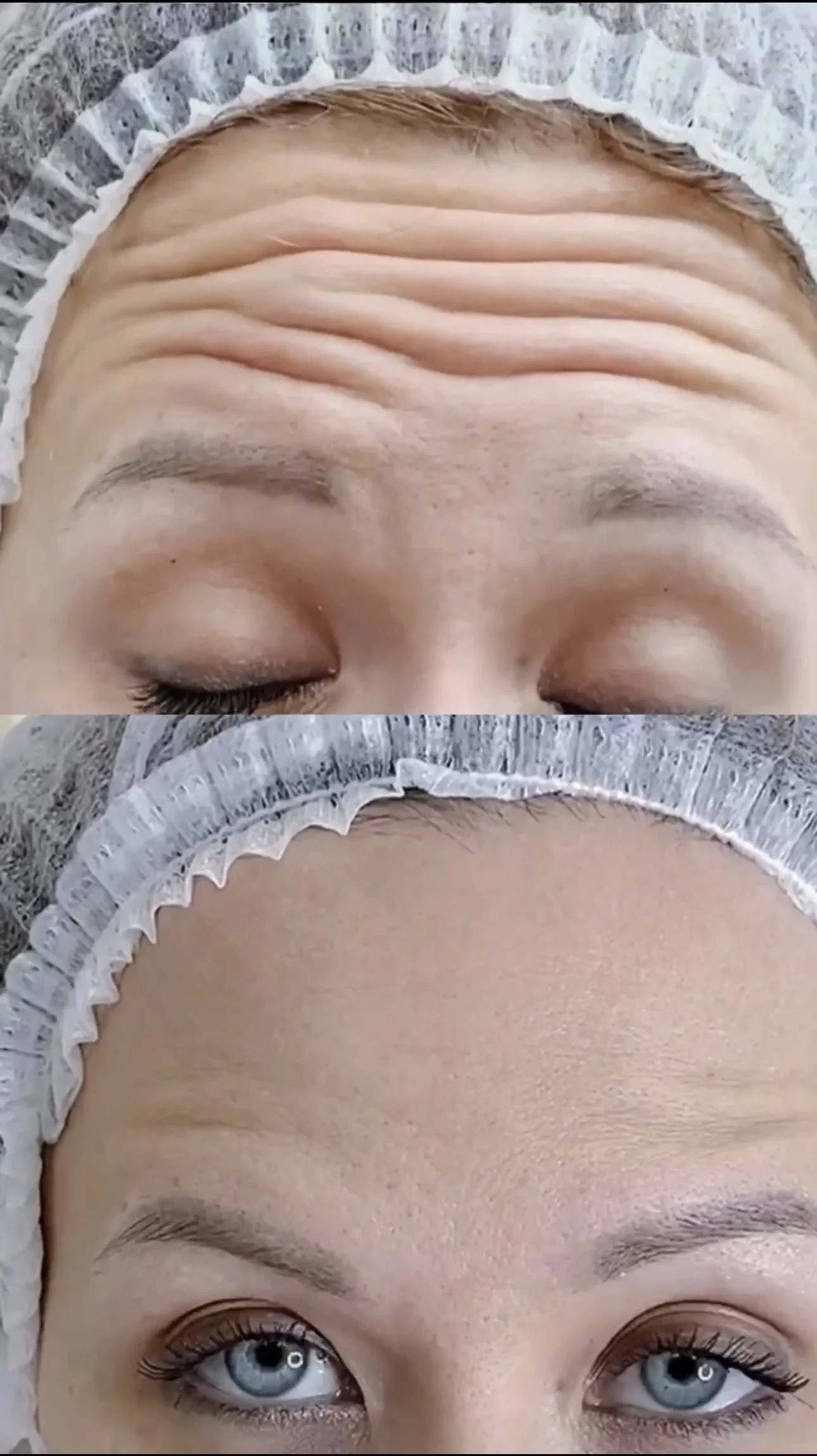 Close-up images of a woman's forehead, closed eyes, and face with blue eyes, lying down with a hair cap and facial treatment.