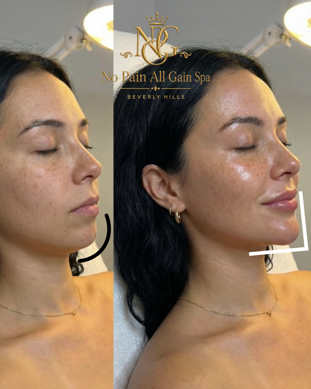 Side-by-side before and after photos of a woman with clear skin, showing improvement in skin tone and texture following a treatment at No Pain All Gain Spa in Beverly Hills.