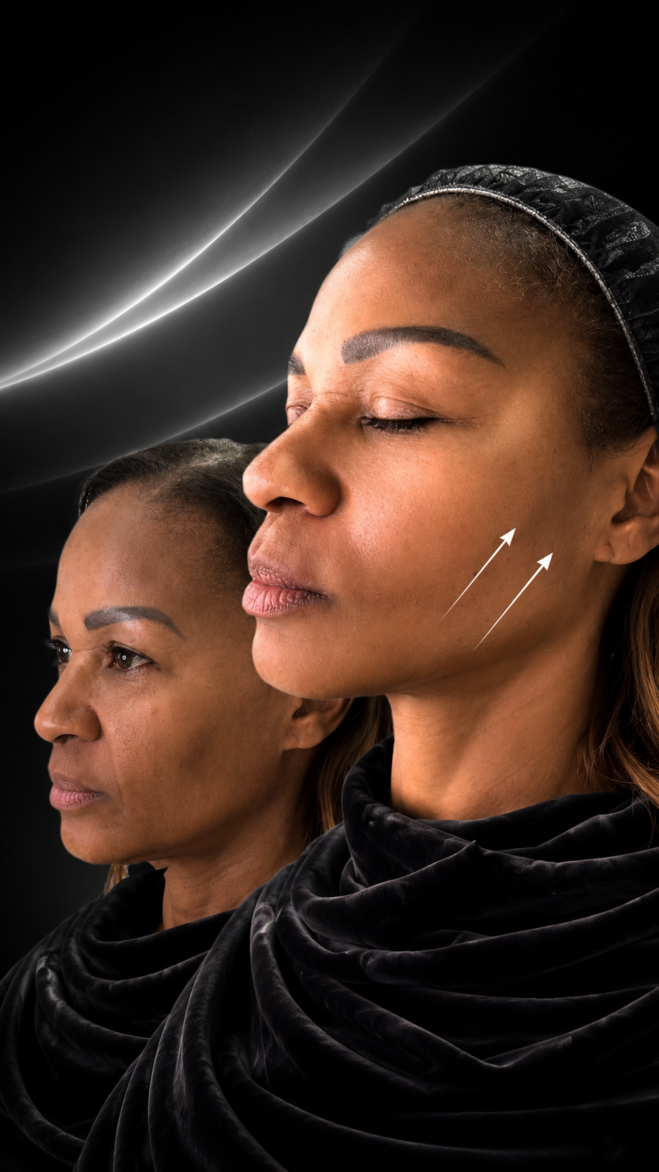 PDO THREAD LIFT BEVERLY HILLS