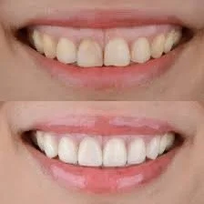 Close-up of a person's smile showing their teeth.