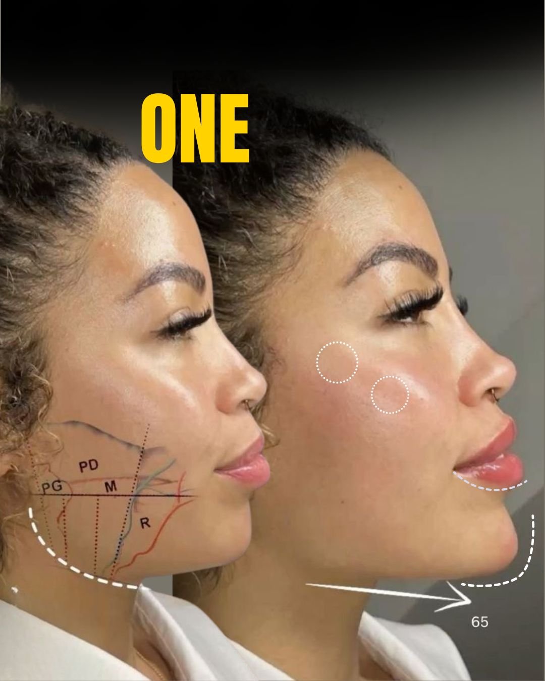 Side profile of a woman before and after cosmetic procedure, with markings and annotations indicating surgical enhancements, including lips and jawline.