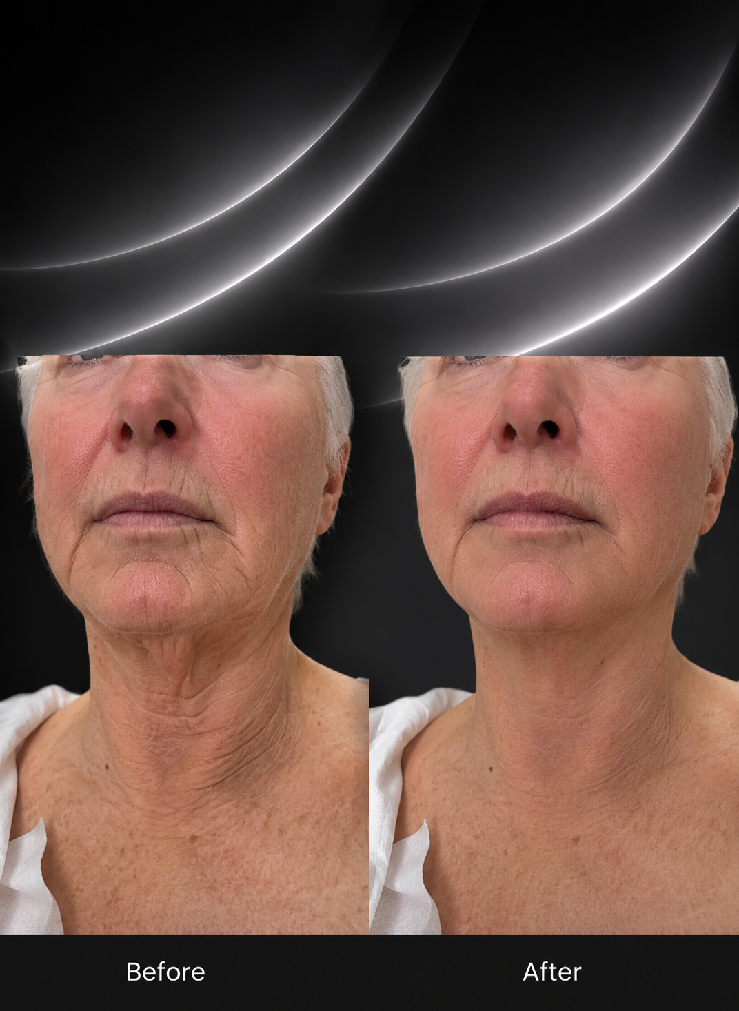 PDO THREADS & RF MICRONEEDLING