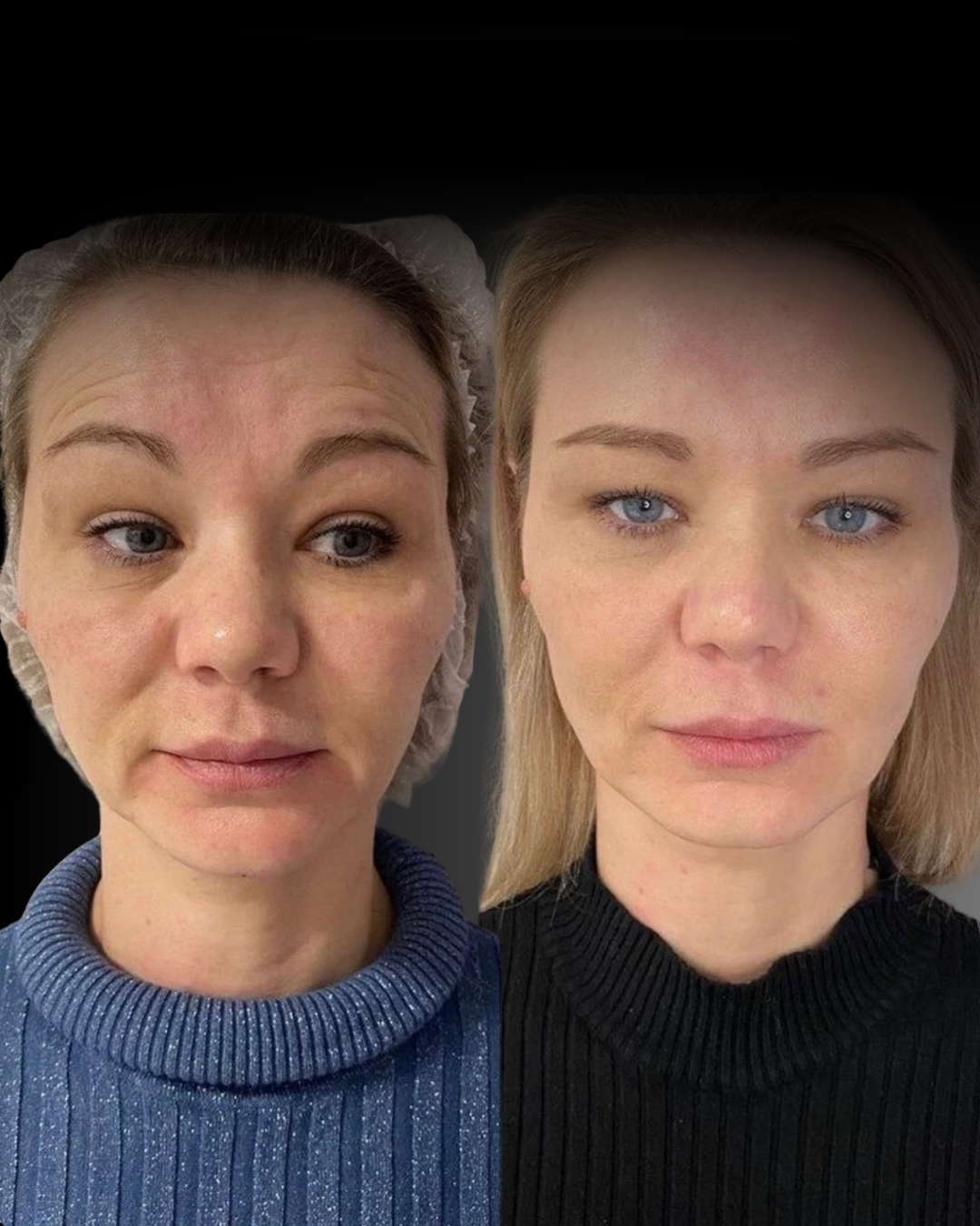 POSTS RADIESSE before & after - 21.png