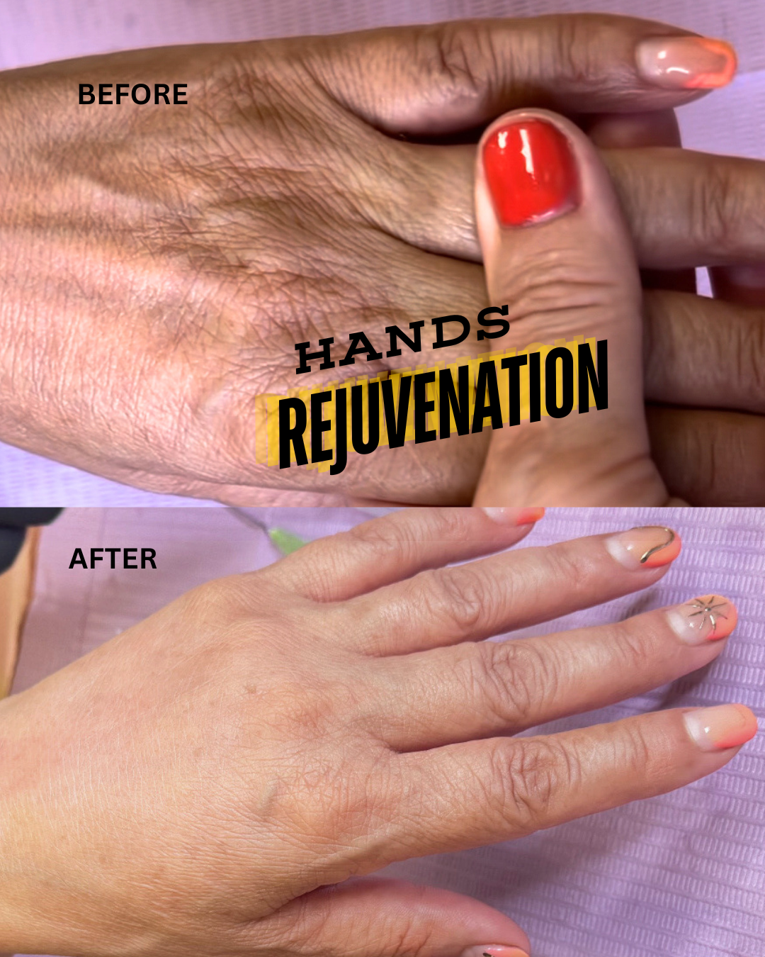 Comparison of hands before and after rejuvenation treatment, showing smoother, younger-looking skin after the procedure with manicured nails.