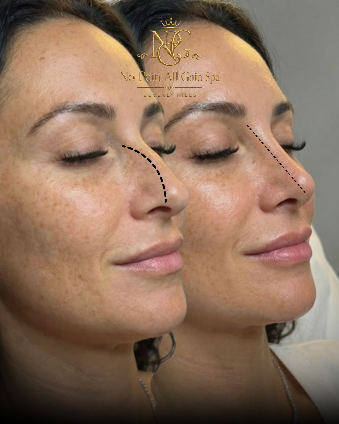 Side-by-side comparison of a woman before and after a cosmetic procedure to straighten her nose, with dotted lines highlighting the change in nasal shape.