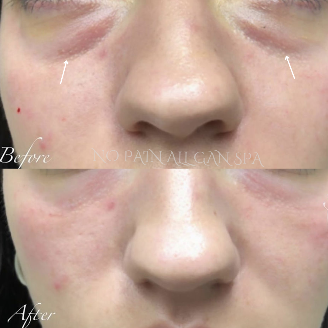 Close-up before and after images showing reduction of under-eye dark circles and puffiness.