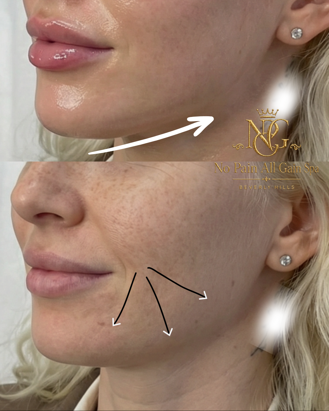 Close-up comparison of a woman's face before and after skincare treatment, showing improved skin texture and reduced pigmentation.