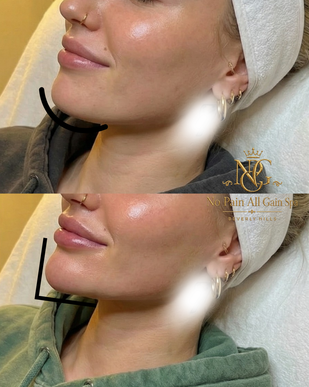Side-by-side comparison of a woman's face before and after a cosmetic procedure, showing fuller lips and a more defined jawline in the after image. The woman is wearing a headband and jewelry, in a spa setting.