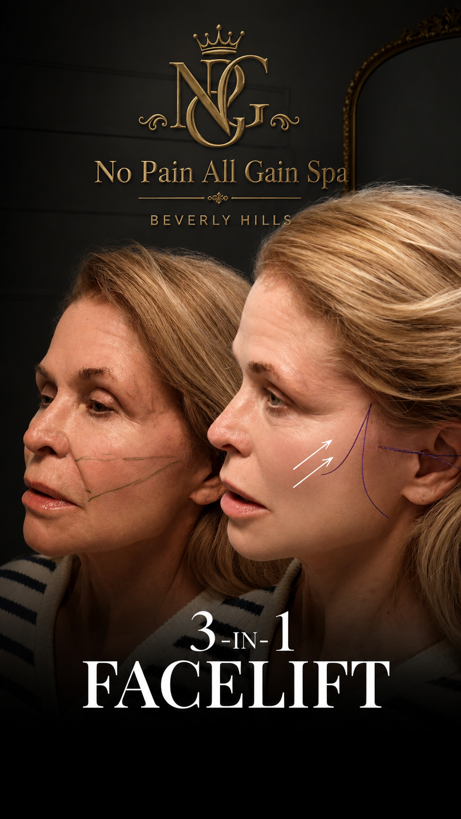 Poster of a skincare or cosmetic clinic with two women showing facial area diagrams, the sign reads 'No Pain All Gain Spa Beverly Hills.' The main text is '3-in-1 Facelift.'