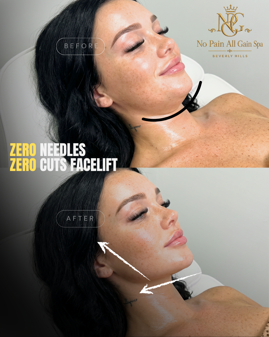 Before and after images of a woman showing improved skin texture and decreased freckles after a facial treatment at No Pain All Gain Spa, Beverly Hills. Labels indicate zero needles and zero cuts with visible effects on her face and neck.