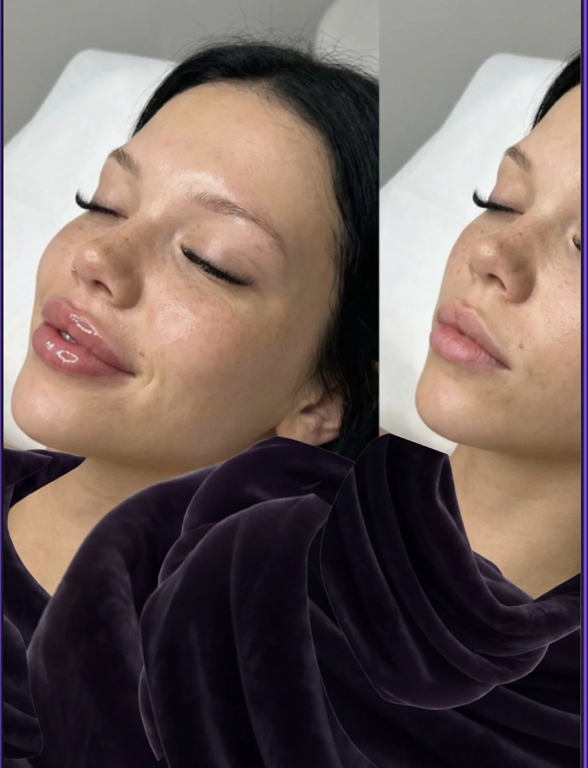 Comparison of a woman's face before and after cosmetic treatment, showing smoother skin with reduced freckles and blemishes.