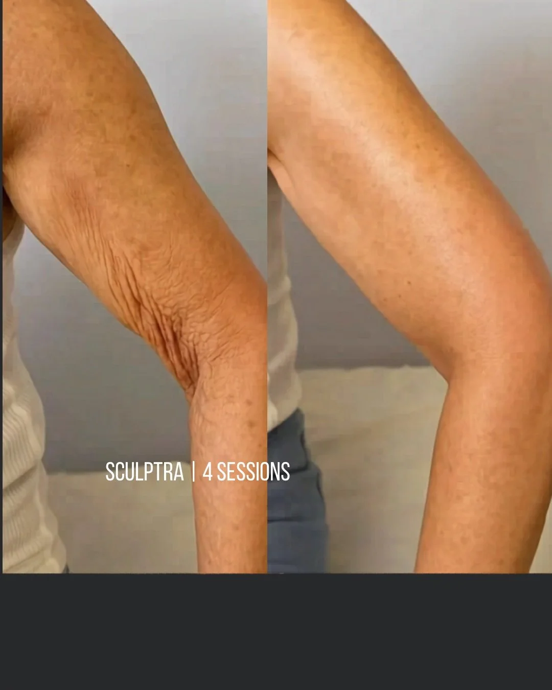 Side-by-side comparison of a person's arm before and after four Sculpttra sessions, showing improved skin tightness and reduced wrinkles.