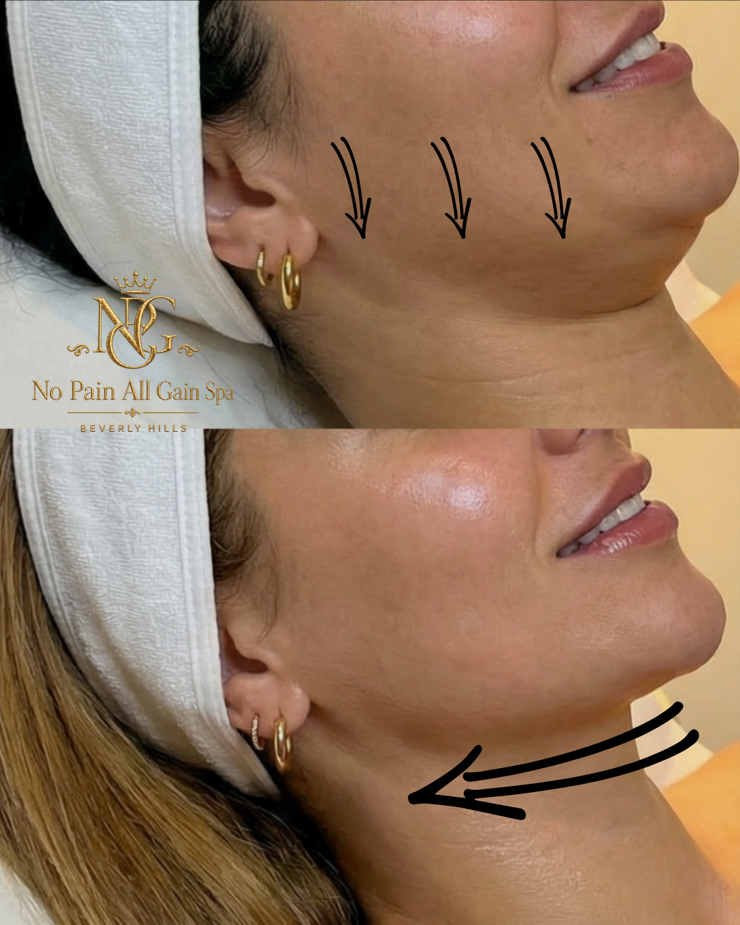 A woman before and after a skincare or cosmetic treatment. The top photo shows her with visible skin imperfections on her cheek, while the bottom photo shows smoother, clearer skin. Arrows indicate the treatment area.