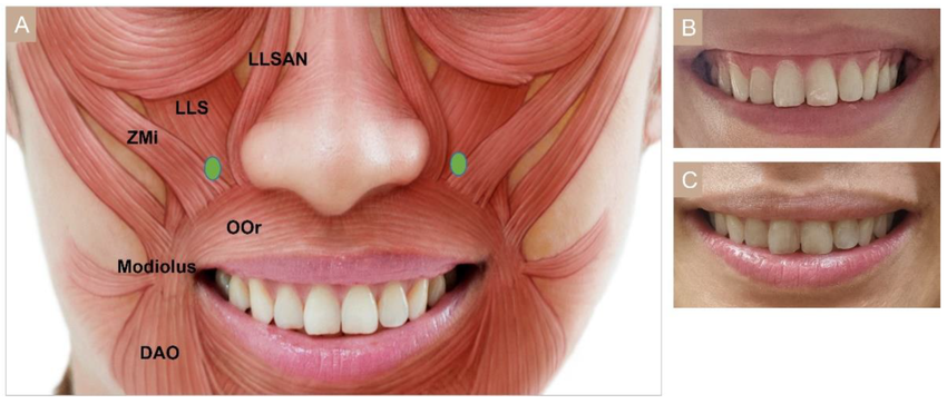 Diagram showing facial muscles around the nose and mouth, including ZMi, LLSAN, LLS, OO, Modiolus, DAO, with photos of a person's teeth in different smile positions.