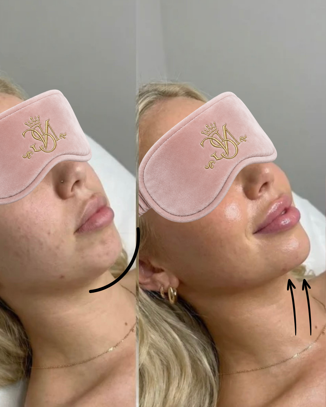 Side-by-side comparison of a woman's face before and after a cosmetic treatment, with a pink sleep mask covering her eyes in both images.