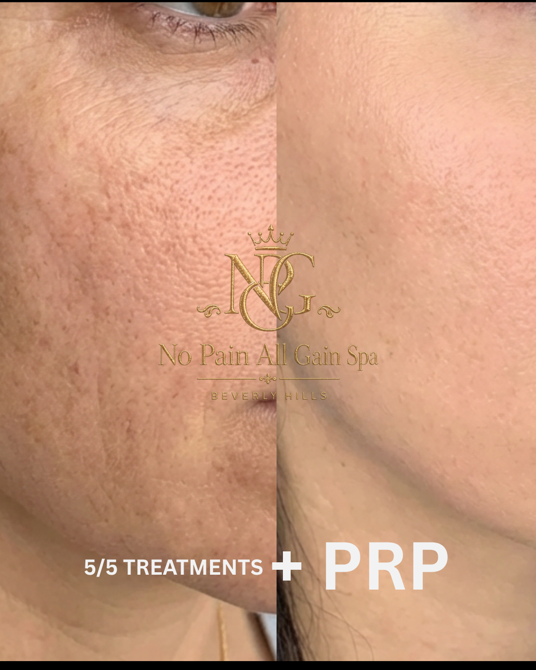Side-by-side comparison of a person's face showing significant acne scars and improved skin texture after treatment, with the text '5/5 Treatments + PRP' and the logo 'No Pain All Gain Spa Beverly Hills'.