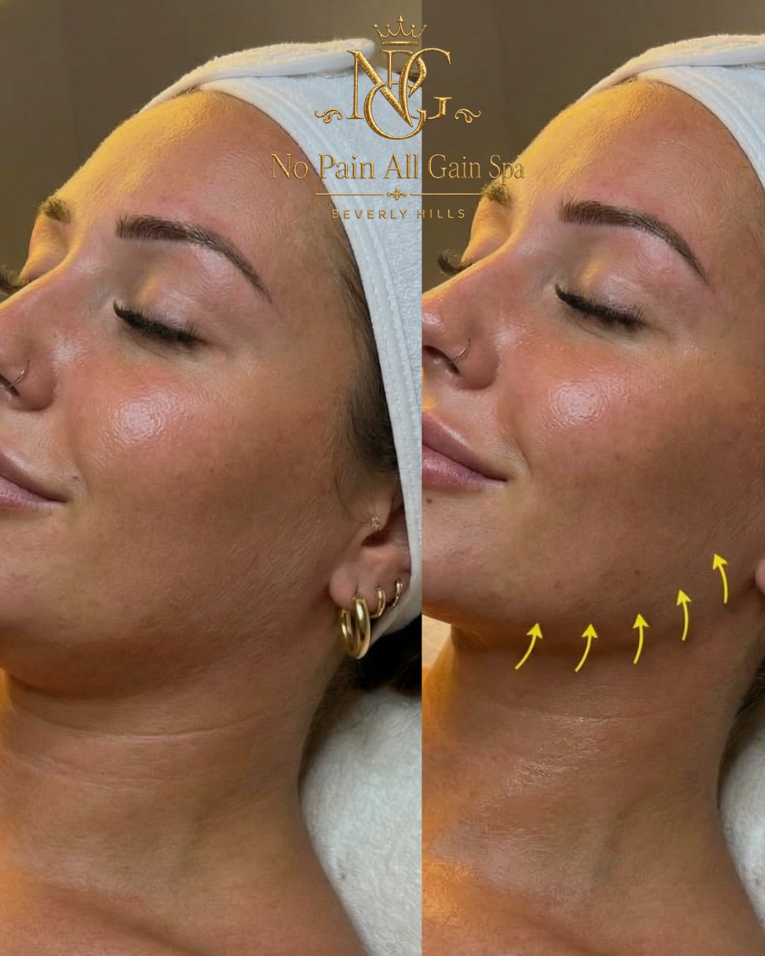 Side-by-side close-up of a woman's face before and after a skin treatment, showcasing improved skin texture and appearance, with yellow arrows indicating the treated area on her neck.