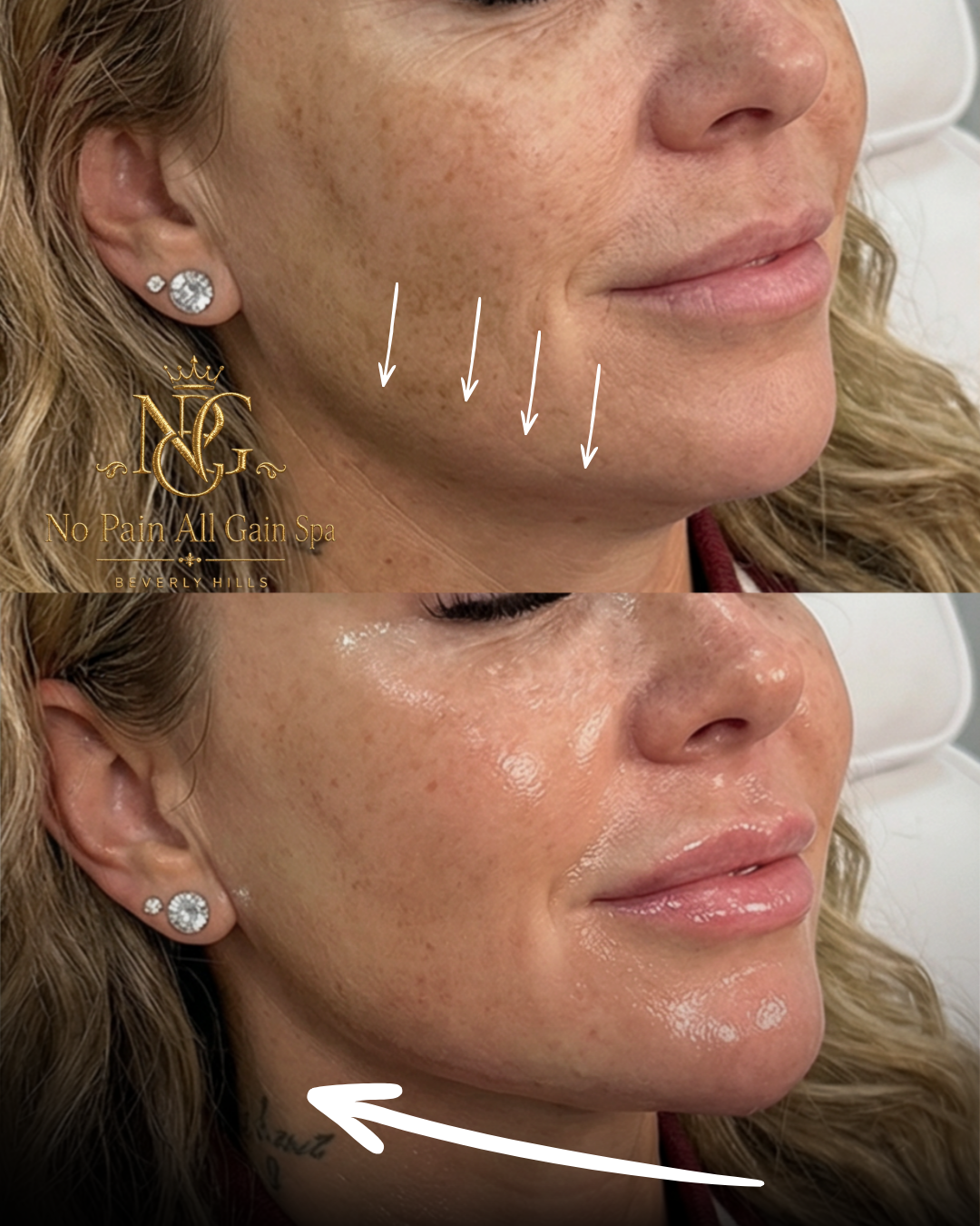 Close-up of a woman's face showing before and after a skincare treatment. The top image highlights the chin area with white arrows pointing to spots or blemishes. The bottom image shows smoother, clearer skin, with an arrow pointing to a tattoo on he