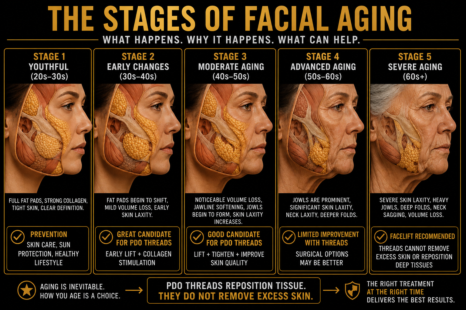 Chart titled 'The Stages of Facial Aging' showing five stages from 20s to 60s+ with demographic age ranges, visual facial diagrams, descriptions of skin changes at each stage, and recommendations for prevention or treatment. Stage 1, youthful, with full fat pads, strong collagen, tight skin; Stage 2, early changes, mild volume loss; Stage 3, moderate aging, volume loss, jawline softening; Stage 4, advanced aging, prominent jowls, skin laxity; Stage 5, severe aging, heavy jowls, deep folds, volume loss. Emphasizes PDO thread repositioning as optimal treatment.